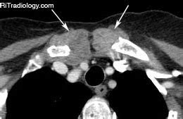 RiT radiology: Sternoclavicular Rheumatoid Arthritis