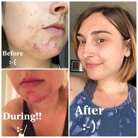 (4) Before and After using Retin-A (Tretinoin 0.025%) never-ending journey over the course of a ...