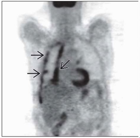 Mesothelioma | Radiology Key