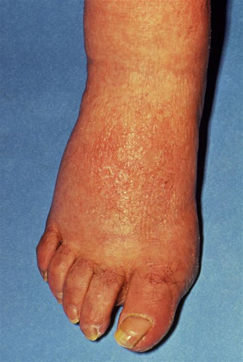 Skin Rashes On Feet