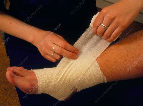 Applying bandage to sprained ankle - Stock Image - M330/0139 - Science Photo Library