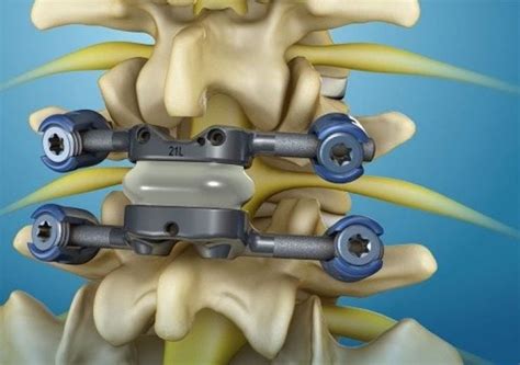 Premia Spine gets FDA breakthrough device status for TOPS spinalsystem