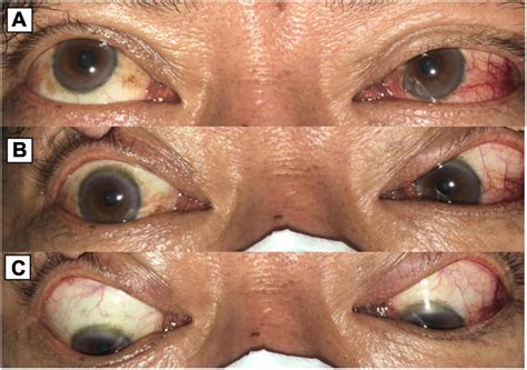 Cavernous Sinus Fistula