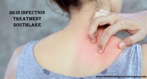 Soft Skin Tissue Infection- Diagnosis and Treatment - Southlake General Surgery