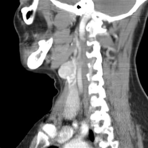 A rare case of laryngeal paraganglioma presenting as a neck mass | Eurorad