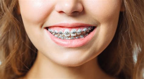 Self-Ligating Braces: Benefits, Cost, and Comparisons