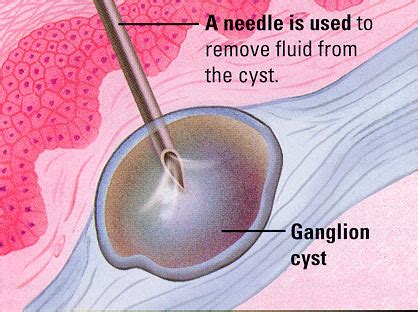 Ganglion Cyst Aspiration