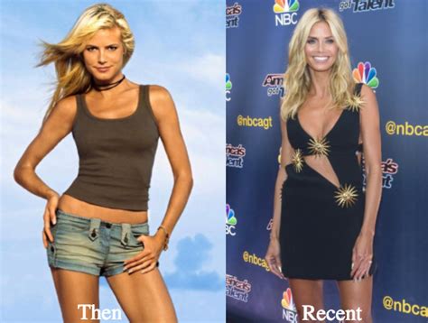 Heidi Klum Plastic Surgery Before and After Photos