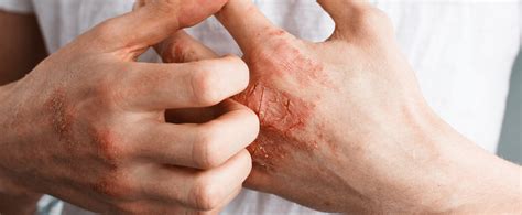Eczema – types, symptoms, and treatment | Eucerin