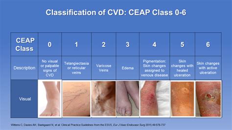 CEAP Classification