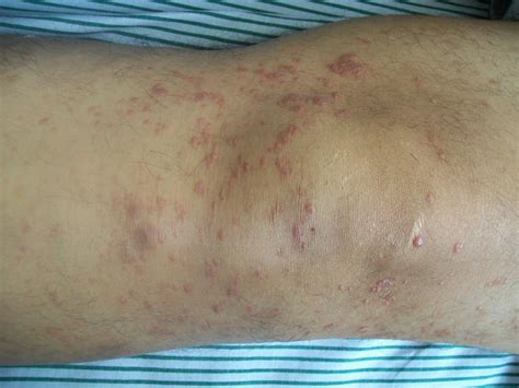 Decoding Lymphoma Rash Signs, Symptoms, and Insights