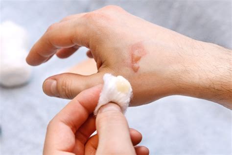 Management of Burn Blisters in Urgent Care - Journal of Urgent Care Medicine