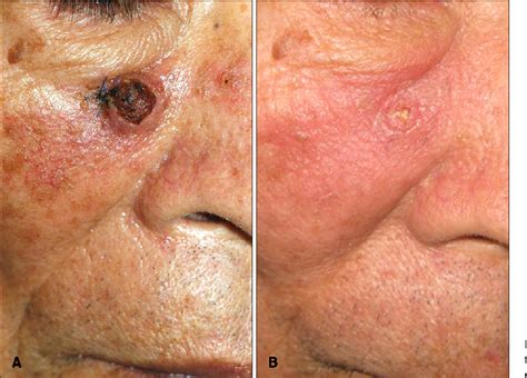 Figure 3 from Treatment of Keratoacanthoma with 5% Imiquimod Cream and Review of the Previous ...