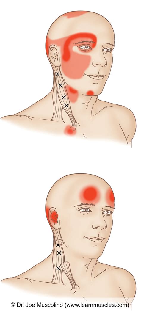 Sternocleidomastoid (SCM) - Trigger Points - Learn Muscles