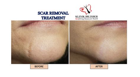 Laser Scar Removal - Scar Removal Treatment - Aesthetic Clinic
