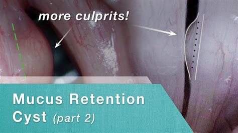 Mucus Retention Cyst | Before and After - Part 2 - YouTube