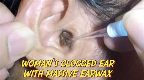 Woman's Clogged Ear with Massive Earwax is Finally Removed - YouTube