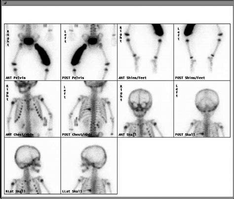 Pre-operative nuclear bone scan showing disease limited to the left ...