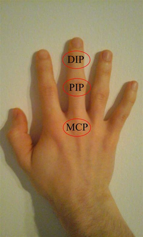 Metacarpophalangeal dislocation (finger) - WikEM