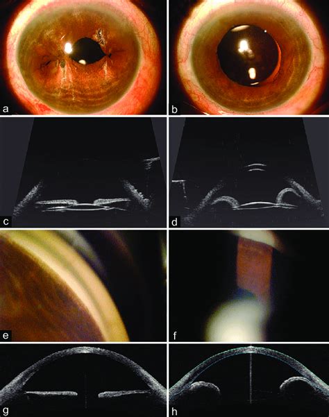 Comparative images of both eyes of a case of angle-closure glaucoma... | Download Scientific Diagram