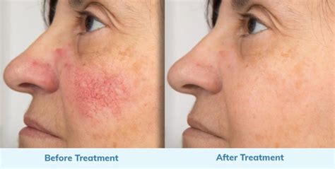 Rosacea Treatment Options, Strategies and Recovery Guidelines