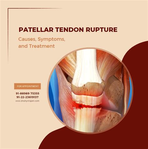 Patellar Tendon Rupture - Causes, Symptoms, and Treatment