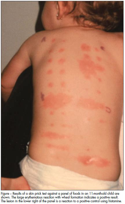 Allergy Testing in Children: Which Test When? | Consultant360