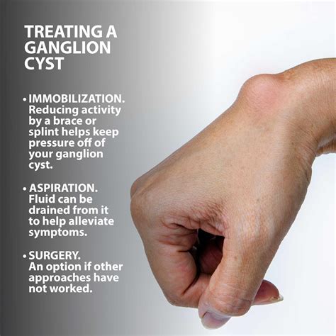 Ganglion Cyst Wrist Treatment| Florida Orthopaedic Institute