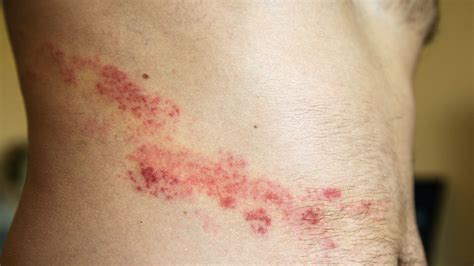 Very red defined rash between buttocks - lalapasale