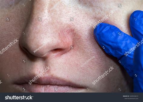 1,335 Bruised Nose Images, Stock Photos & Vectors | Shutterstock