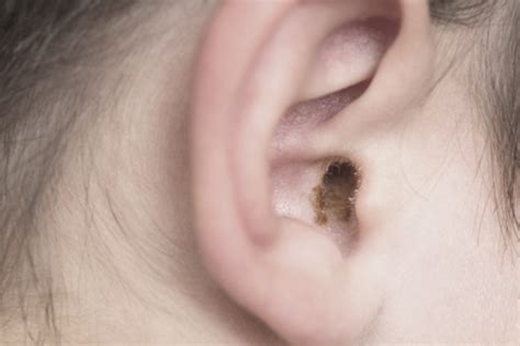 What Is Ear Wax? And How Much Is Too Much?