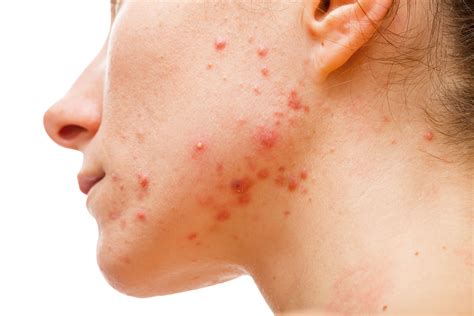 Acne vulgaris increases with hidradenitis suppurativa | Dermatology ...