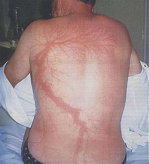 Burn pattern after guy survives lightning strike! : natureismetal