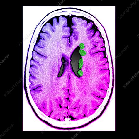 Heterotopic Gray Matter, MRI - Stock Image - C004/7513 - Science Photo Library