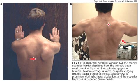 Scapular Winging - Shoulder & Elbow - Orthobullets