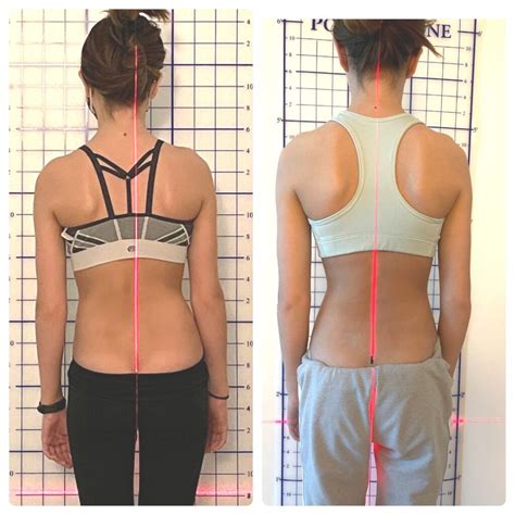 Torso Re-Shaping with Scoliosis-Specific Exercises and Custom Bracing | National Scoliosis Center