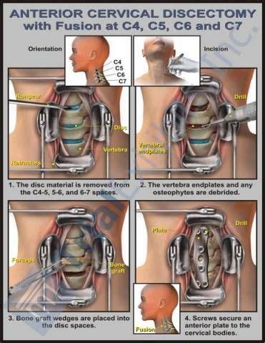 Anterior Cervical Discectomy w/ Fusion C4, C5, C6, C7 - Spine Surgery ...