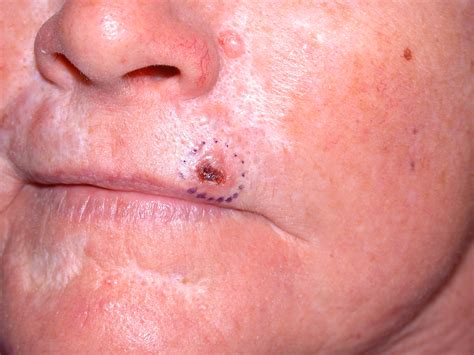 Basal Cell Carcinoma Lip