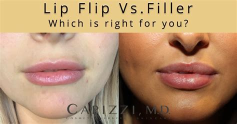 Lip flip or lip filler — which is right for you? - Capizzi MD