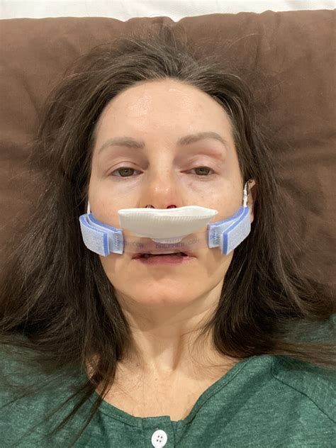 What is it like to have a Septoplasty? – The Maternal Hobbyist