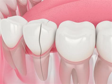 4 Ways to Fix a Cracked Tooth - Austin Laser Dentist - Helen Ragsdale DDS - Austin Dentist