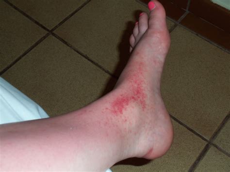 heat rash on foot pictures - pictures, photos