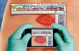 Wound measurement tools: Your guide to what works best