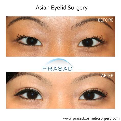 How is a Double Eyelid/ Eyelid Crease Created? | Dr. Prasad Blog