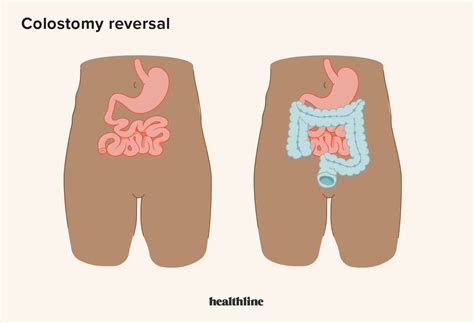 Life After a Colostomy Reversal: What To Expect