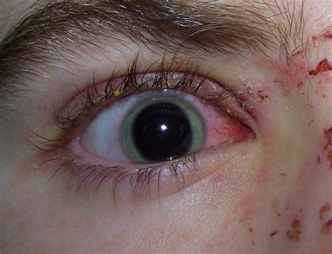 File:Eye Injury.jpg - Wikipedia