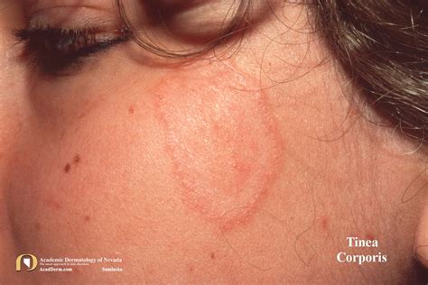 Tinea Corporis: Ringworm, Tinea Circinata... - Academic Dermatology of Nevada