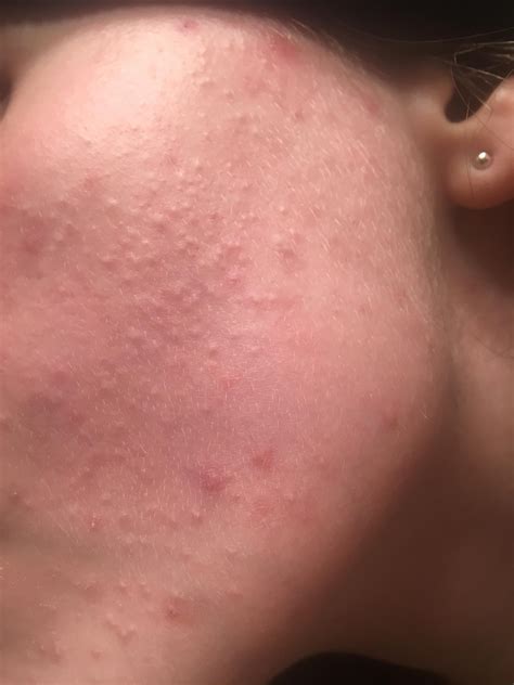 Small flesh colored bumps on cheeks - General acne discussion - Acne.org