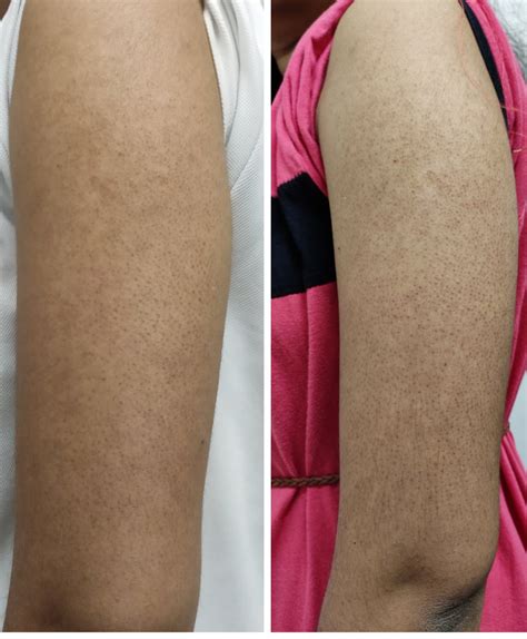 KP Before And After : r/keratosis