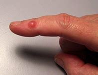 A red nodule on the finger | Medicine Today